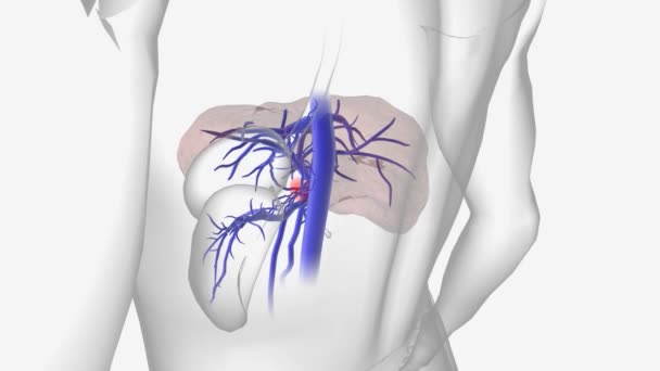 门静脉血栓形成 Pvt 是指血凝块导致门静脉狭窄或阻塞 — 图库视频影像