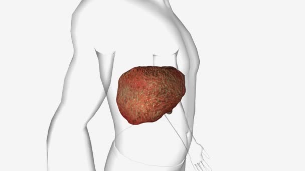 原发性胆管炎肝硬化3D — 图库视频影像