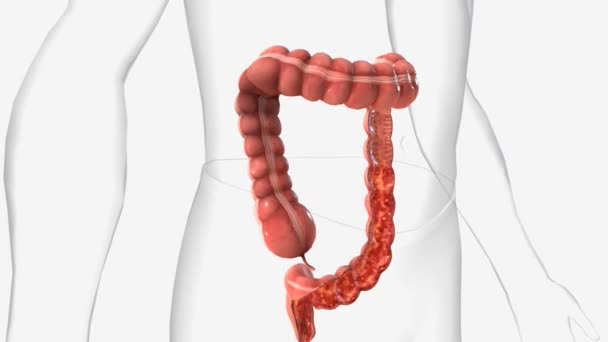 Ulcerative Colitis Inflammatory Bowel Disease Causes Inflammation Ulcers Sores Your — Stock Video