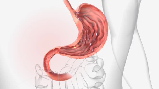 胃潰瘍 胃潰瘍 胃の内側に発生するオープンソースです — ストック動画