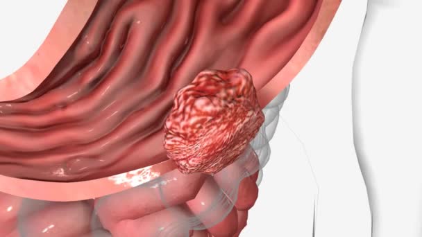 胃がんとは 胃の内側に悪性 細胞ができる病気です — ストック動画