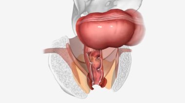 Fecal incontinence, also called accidental bowel leakage, is the accidental passing of solid or liquid stools from your anus