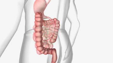 Birincil Biliary Cholangitis Siroz 3D