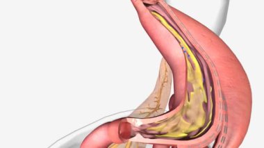 Kol Gastrectomy, Mide 3D animasyonu