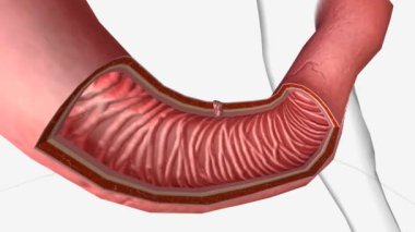 Duodenal karsinom (ayrıca ince bağırsak adenokarsinom olarak da bilinir), onikiparmak bağırsağını etkileyen nadir bir kanser türüdür..