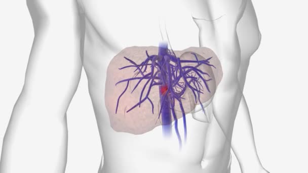门静脉血栓形成 Pvt 是指血凝块导致门静脉狭窄或阻塞 — 图库视频影像