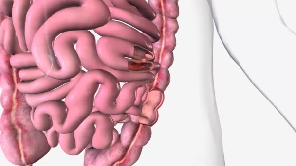 Intestines 3D渲染的Fistula — 图库视频影像