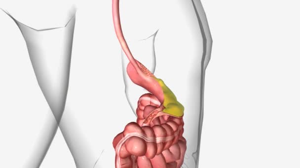 Gastric Outlet Obstruction Goo Result Any Disease Process Causes Mechanical — Stock Video