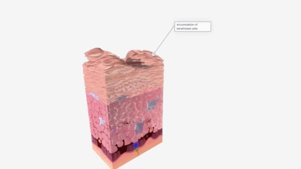 表皮細胞性一糖症 Epidmolytic Ichthyosis 皮膚の水ぶくれやスケーリングの程度が異なることが特徴である遺伝性皮膚障害である — ストック動画