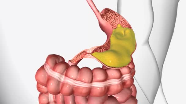 胃出口閉塞 Goo 胃の空に機械的な障害を引き起こすあらゆる疾患プロセスの結果です — ストック動画