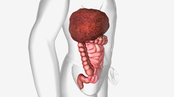Цироз Англ Cirrhosis Пізнє Захворювання Печінки Якому Здорова Тканина Печінки — стокове відео
