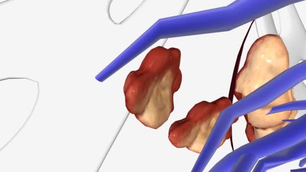 Rektal Kanser Evresi Karaciğerde Metastatik Kolokteral Kanser — Stok video