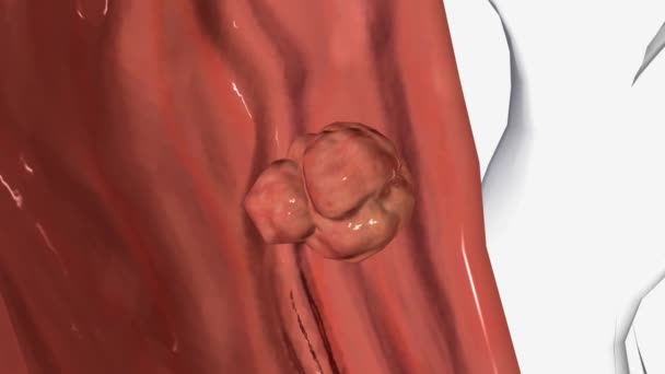 Rectal Cancer Stage Primary Colocteral Cancer Tumor — Stock Video