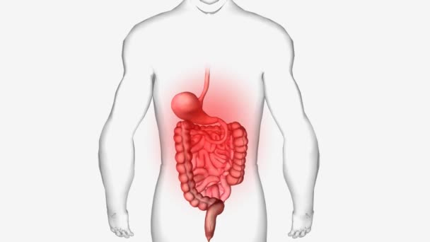 Gastroenteritis Inflammation Lining Stomach Intestines — Stock Video