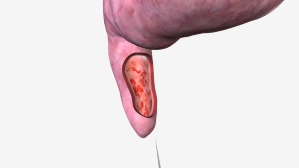 直腸炎は直腸の裏地の炎症です 治療は 急性または慢性かもしれません — ストック動画