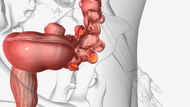食管炎和食管炎是影响大肠 的相关消化系统疾病 — 图库视频影像