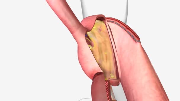 胃与胃旁路 胃水壶的胃 — 图库视频影像