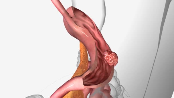 胃癌是一种恶性肿瘤细胞在胃内壁形成的疾病 — 图库视频影像