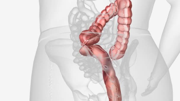 Cirugía Anastomosis Intestinal Refiere Procedimiento Médico Utilizado Para Conectar Dos — Vídeo de stock