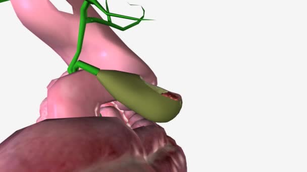 Gallbladder Cancer Disease Which Malignant Cancer Cells Form Tissues Gallbladder — Stock Video