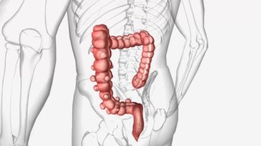 Divertiküloz, sindirim sisteminin herhangi bir bölümünün duvarında ya da yüzeyinde küçük keselerin ya da ceplerin bulunduğu bir durumdur.