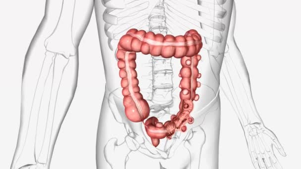 Diverticulosis Condition Which Small Pouches Pockets Wall Lining Any Portion — Stock Video