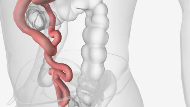 横腸アナストモシス 横腸アナストモシス 腸の切断端を縫合または固定した手術の一種である — ストック動画