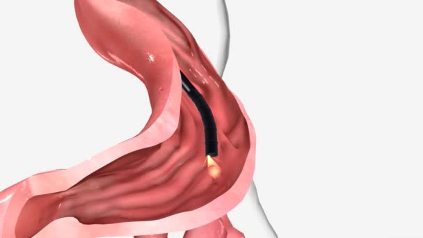 急性腹部の内視鏡的腹部探査 — ストック動画