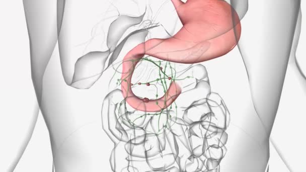 十二指肠癌 又称小肠腺癌 是一种罕见的癌症 它影响到十二指肠 即小肠中离胃最近的部分 — 图库视频影像