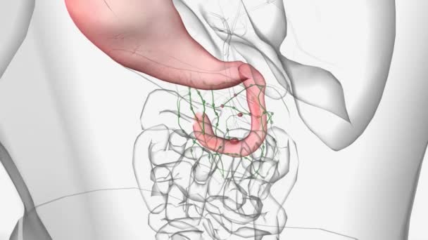 十二指腸がんは小腸腺癌とも呼ばれ 胃に最も近い小腸の一部である十二指腸に影響を及ぼすまれながんです — ストック動画