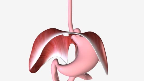 食道ヘルニアまたは裂孔ヘルニアは 胃の一部が胸腔に食道のHiatusを介して突出した場合に発生します — ストック動画