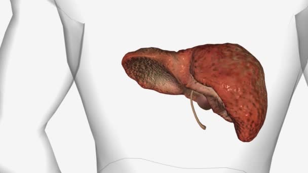 原发性胆管炎 肝硬化 — 图库视频影像