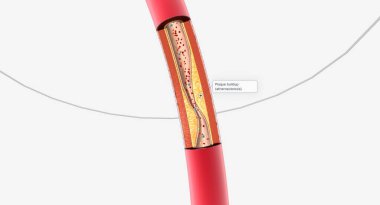 Atherosclerosis is the plaque buildup in the walls of the arteries. 3D rendering
