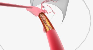 Atherosclerosis is the plaque buildup in the walls of the arteries. 3D rendering