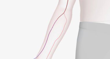 Radyal arterden kateter ilerlemesi. 3B Hazırlama