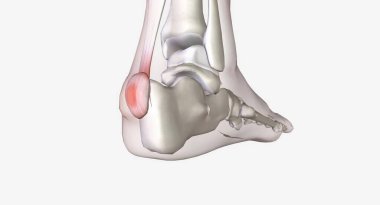 Haglund 'un deformasyonu topuğun arkasındaki kemik büyümesi.