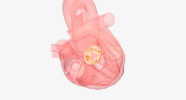 Aort kapakçığı yenileme ve onarım aort stenozunu tedavi etmek için açık kalp cerrahisi prosedürleridir. Dar kalp kapakçığı düzgün açılıp kapanmaz. 3B görüntüleme