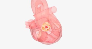 Aort kapakçığı yenileme ve onarım aort stenozunu tedavi etmek için açık kalp cerrahisi prosedürleridir. Dar kalp kapakçığı düzgün açılıp kapanmaz. 3B görüntüleme