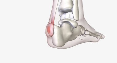 Haglund 'un deformasyonu topuğun arkasındaki kemik büyümesi.