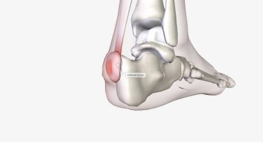 Haglund 'un deformasyonu topuğun arkasındaki kemik büyümesi.
