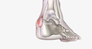 Haglunds deformasyonu, topuğun arkasındaki kemik büyümesidir.