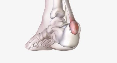 Haglund 'un deformasyonu topuğun arkasındaki kemik büyümesi.