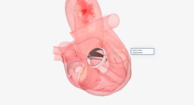 Hasarlı aort kapakçığı, kapakçığın etrafındaki halkayı sıkılaştırarak, kapakçığı ya da kapakçığı tıkayarak, kaynaşmış kapakçığı ayırarak ya da kapakçığa destek ekleyerek onarılabilir. 3B görüntüleme