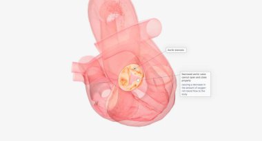 Aort kapakçığı yenileme ve onarım aort stenozunu tedavi etmek için açık kalp cerrahisi prosedürleridir. Dar kalp kapakçığı düzgün açılıp kapanmaz. 3B görüntüleme