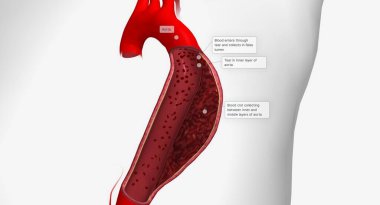Aortic dissection is a serious cardiovascular condition characterized by a tear in the inner layer of the aorta. 3D rendering