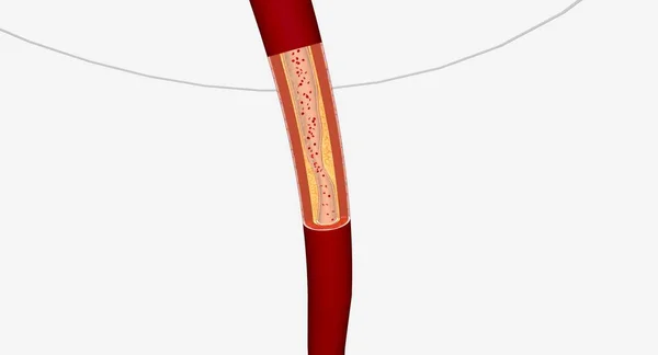 下肢狭窄的血管下肢动脉介入治疗可包括血管成形术 支架置换术或无神论者切除术 3D渲染 — 图库照片