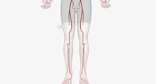 Alt Ekstremite Arteriyel Müdahaleler Bacaklarınıza Ayaklarınıza Kan Akışını Geri Getirmek — Stok fotoğraf