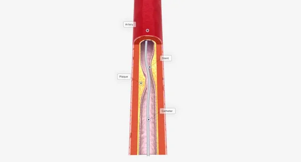 성형술은 폐색된 동맥을 확장하기 사용하는 침습적 시술입니다 렌더링 — 스톡 사진