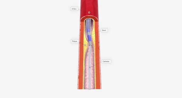 血管成形术是一种微创的手术 它使用带有气球尖的导管来扩张你堵塞的动脉 3D渲染 — 图库照片