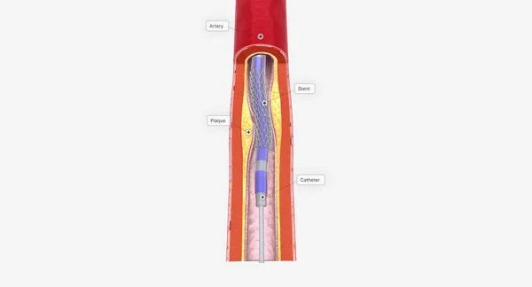 Angioplastica Una Procedura Minimamente Invasiva Che Utilizza Catetere Con Punta — Foto Stock